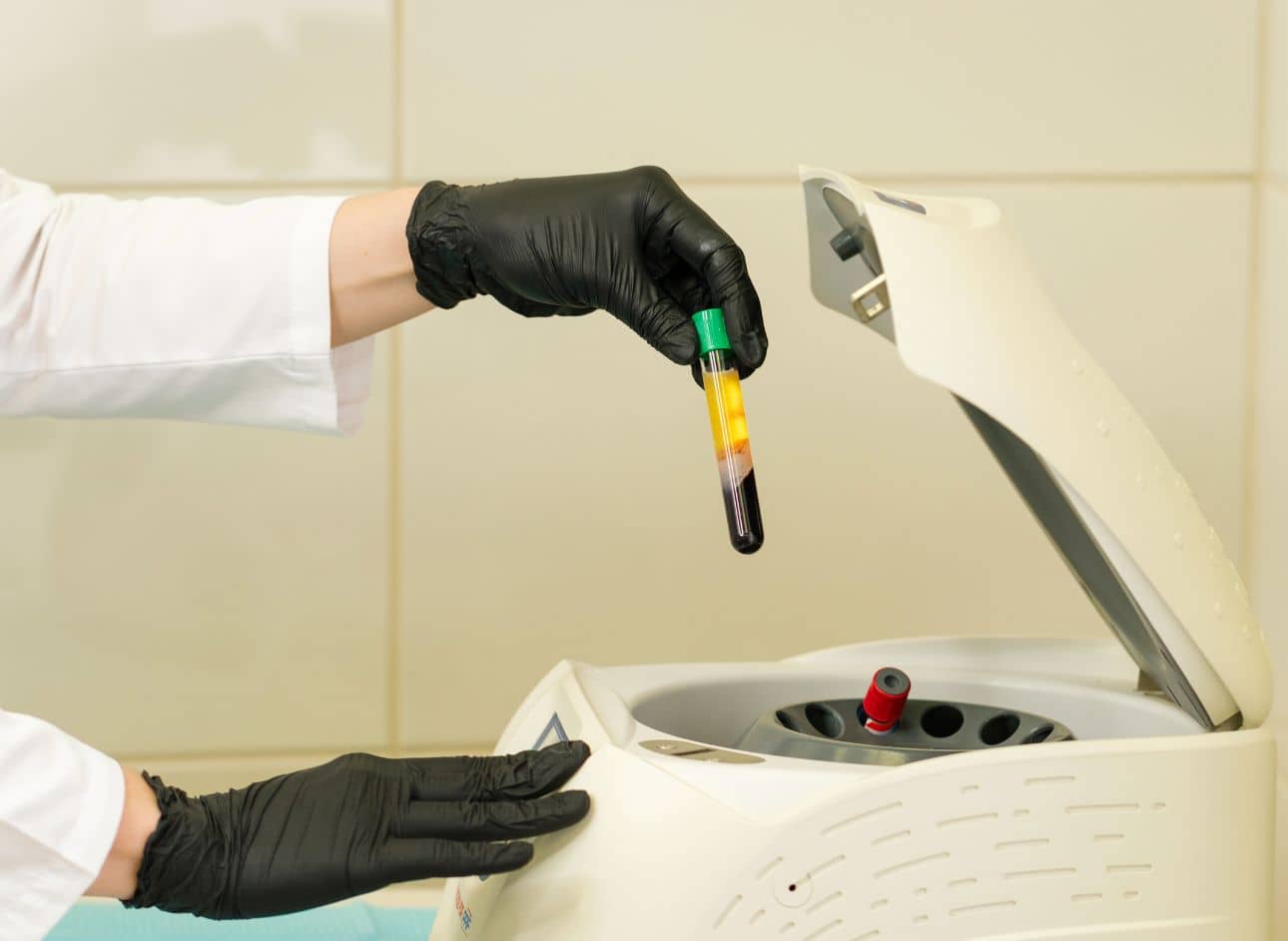 Platelet-Rich Plasma (PRP)