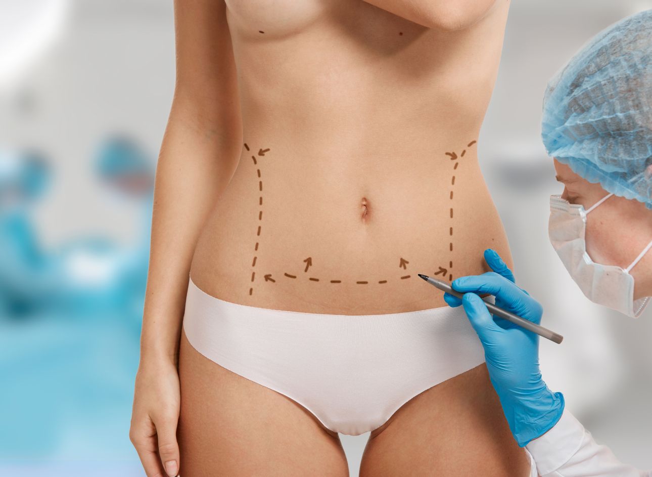 Tummy Tuck