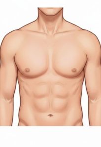 gynecomastia in Dubai