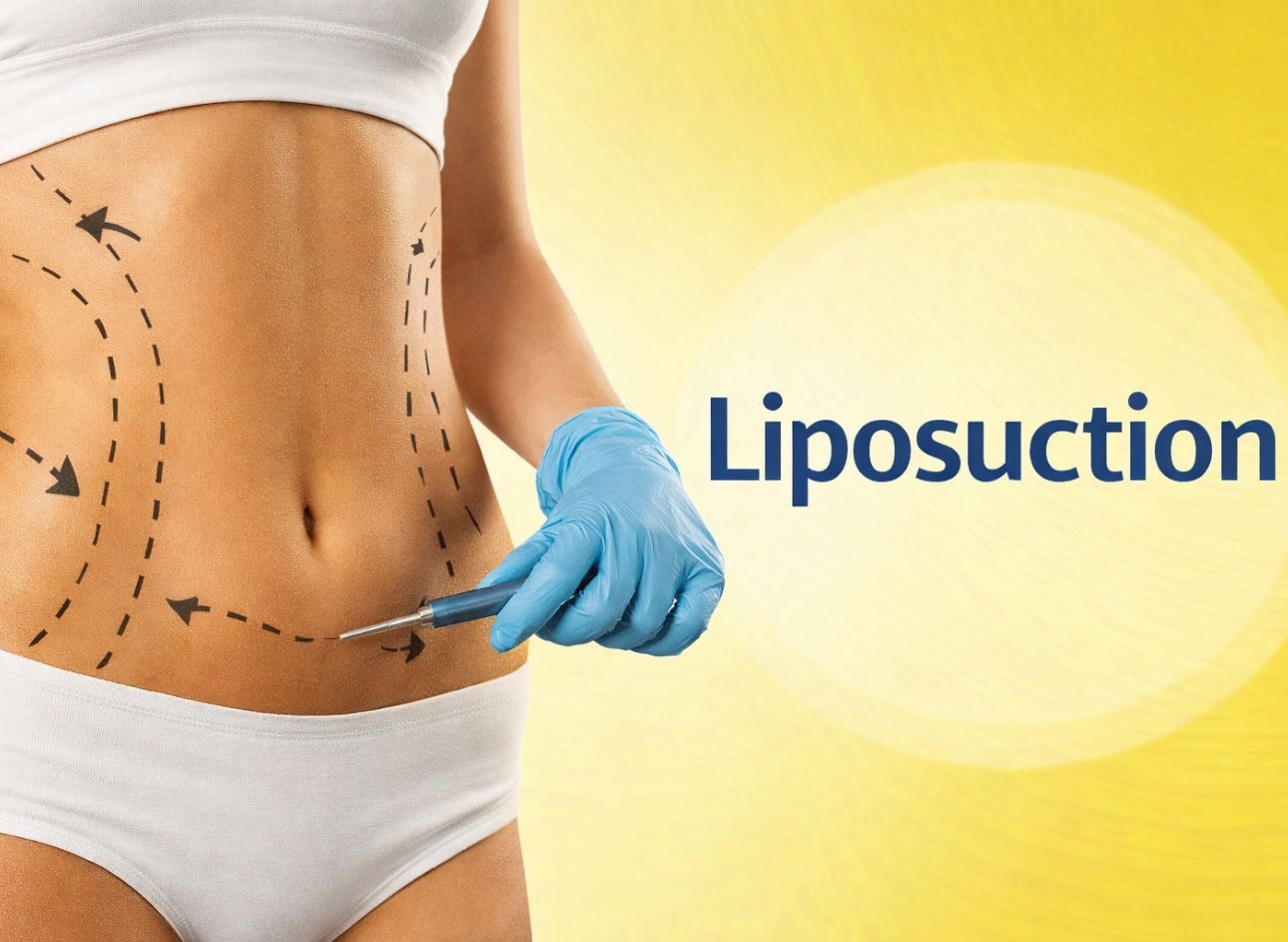 liposuction