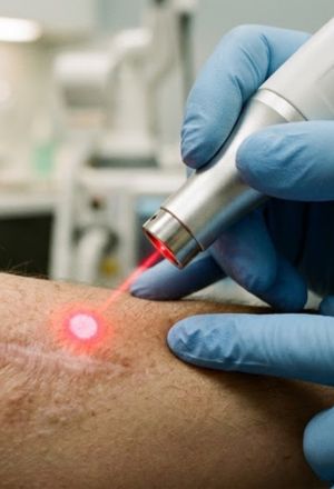 Fotona Laser